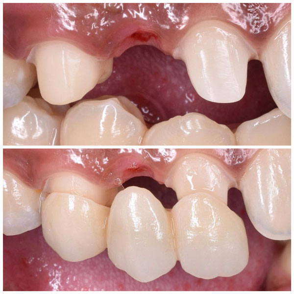 Dental Bridge Before And After