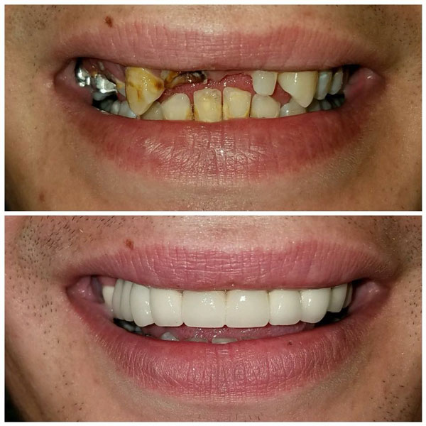 Dental Bridges-before-and-after-8