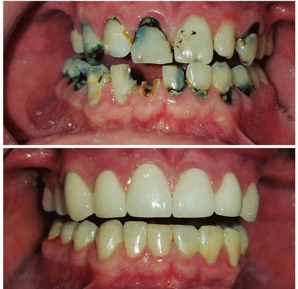 cosmetic-bonding-before-and-after-9