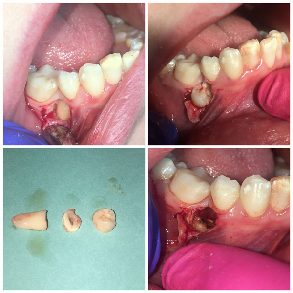 extractions-before-and-after-1