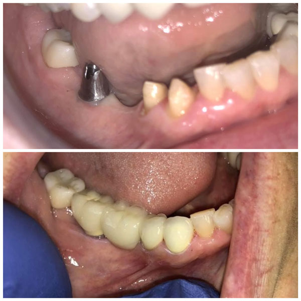 dental implant before and after