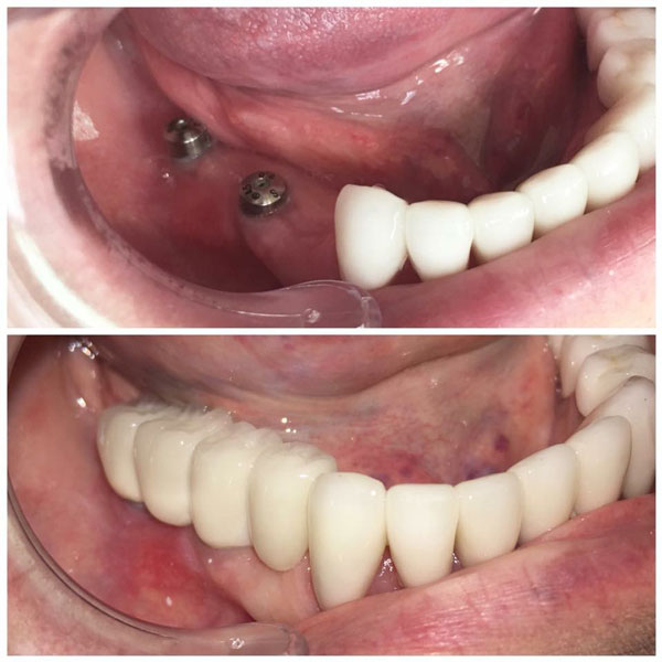 tooth implant before and after