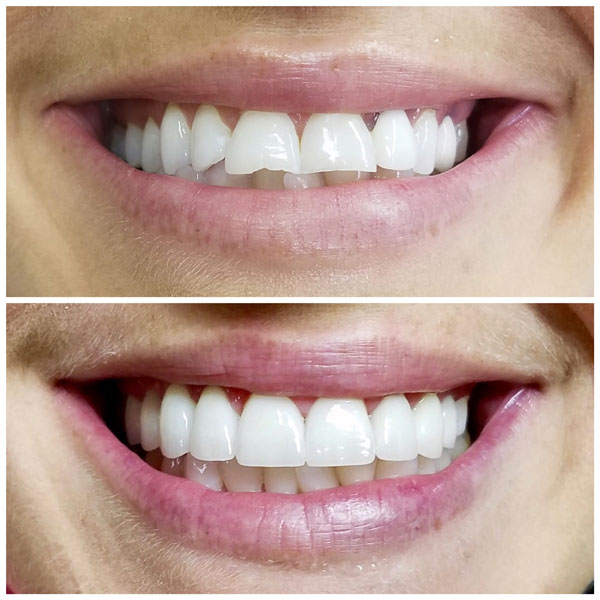 porcelain-veneers-before-and-after-1