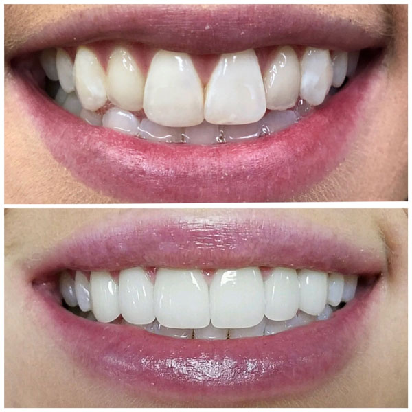 Dental Veneers In Garland, TX | Dental Veneers Near Me