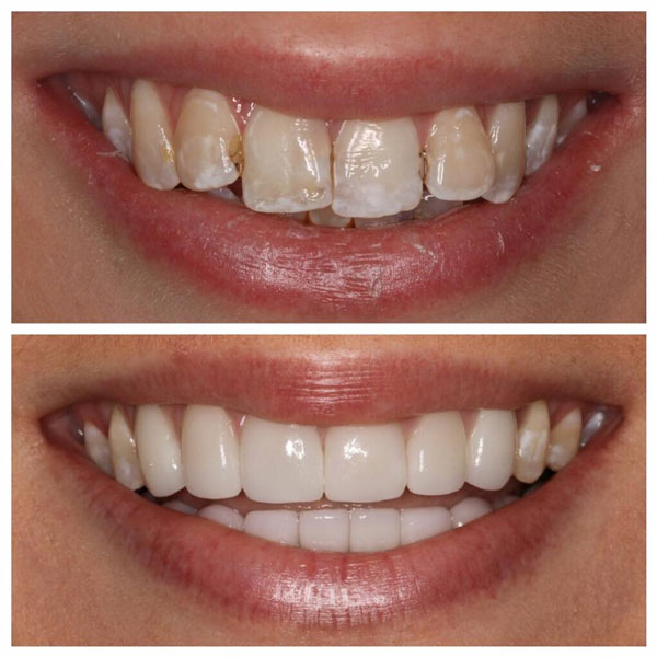 Veneers Near Me Before And After | Dunce Academy